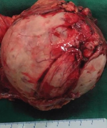 Well-encapsulated right adrenal tumour.